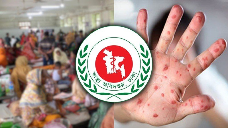 হাম উপসর্গে আরও ৬ জনের মৃত্যু, মোট মৃত ১,০৩৬