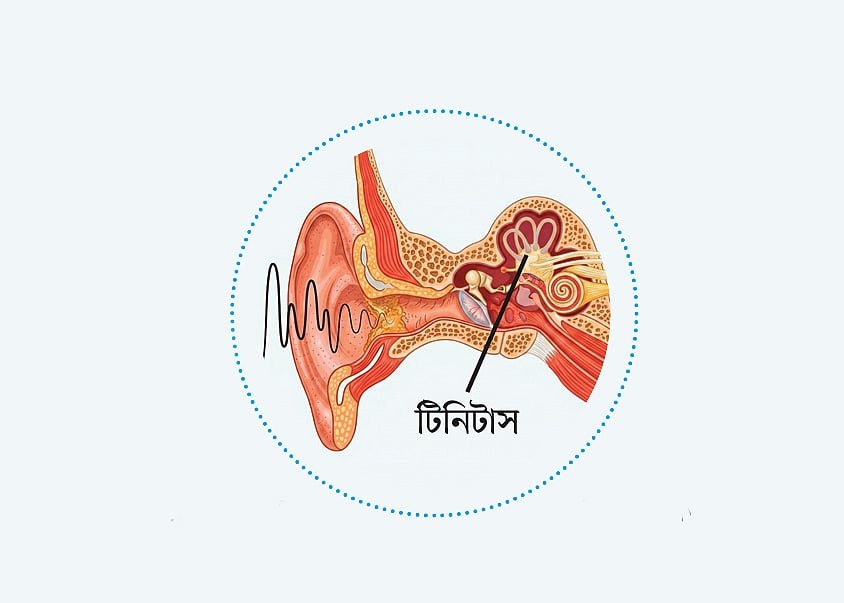 টিনিটাস কী, এতে কানে কী হয়